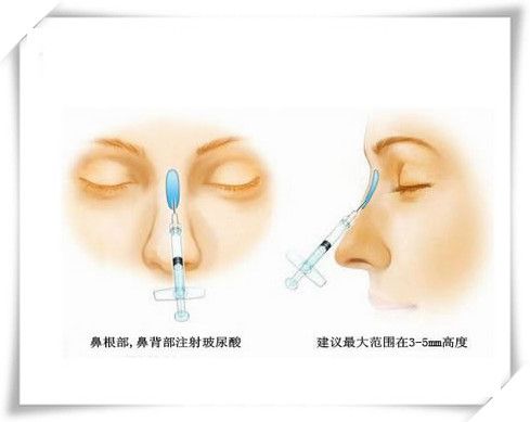 注射型隆鼻术